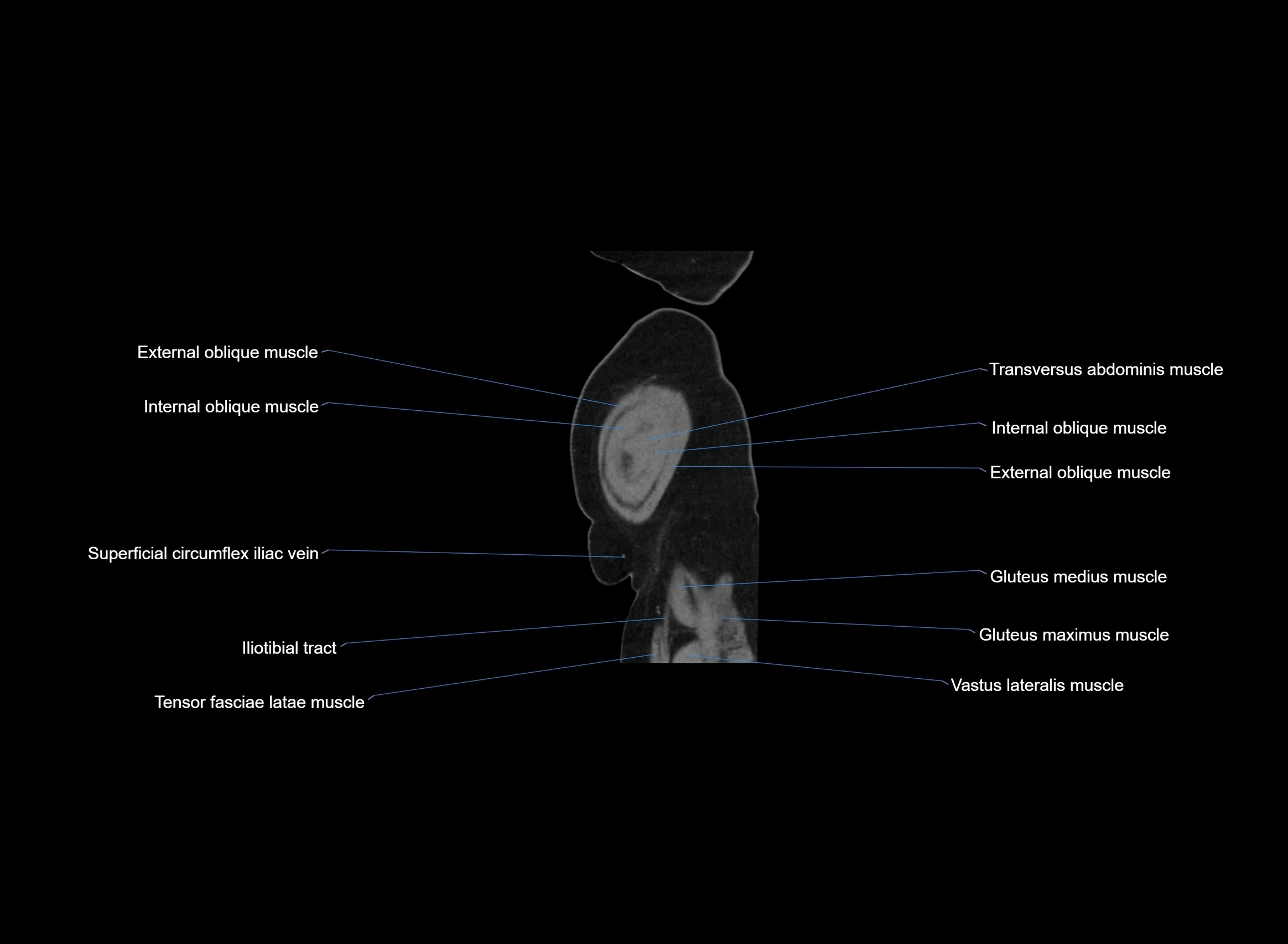 CT Abdomen sagittal cross sectional anatomy labelled radiology image -00006.webp